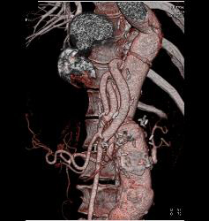Bypass Grafts in Patient With Diseased SMA/celiac - CTisus CT Scan