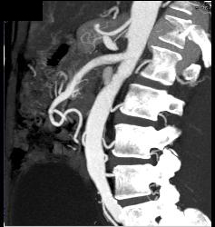 Median Arcuate Ligament Syndrome - CTisus CT Scan