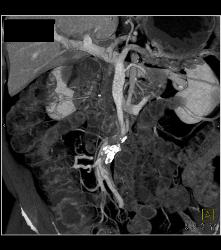 Midline Hernia of Small Bowel Obstruction (SBO) - CTisus CT Scan