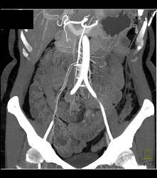 Carcinoid Tumor in Ileum - CTisus CT Scan