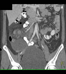 Acute Appendicitis and Ovarian Cyst - CTisus CT Scan
