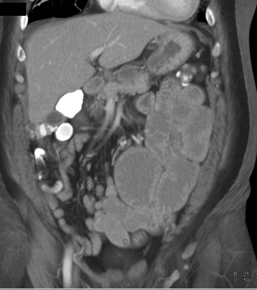 Small Bowel Obstruction due to Incisional Hernia in Abdominal Wall - CTisus CT Scan