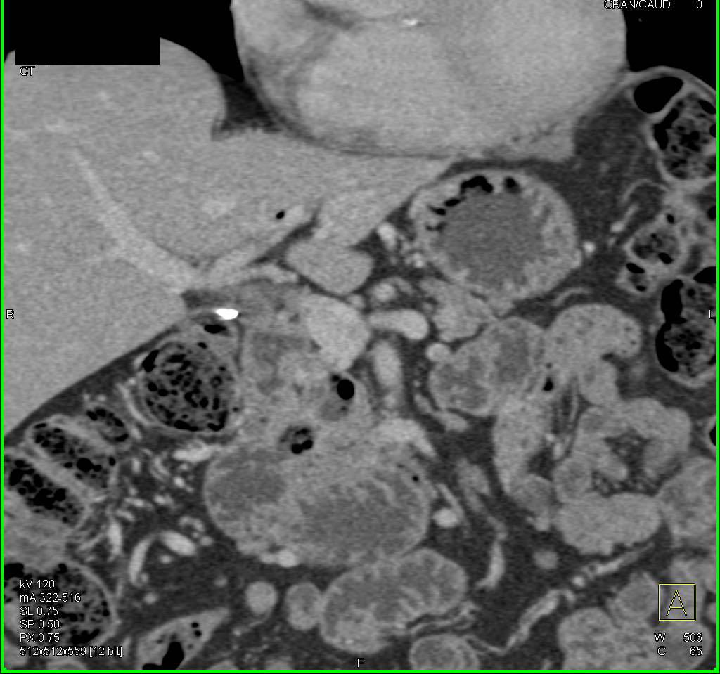 Duodenal Diverticulum - CTisus CT Scan