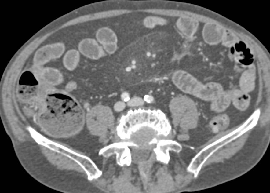 Mesenteric Panniculitis - CTisus CT Scan