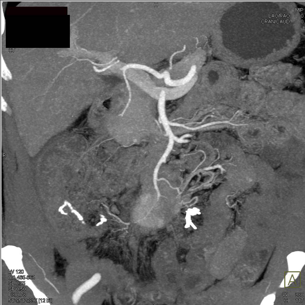 Carcinoid Tumor in the Mesentery - CTisus CT Scan