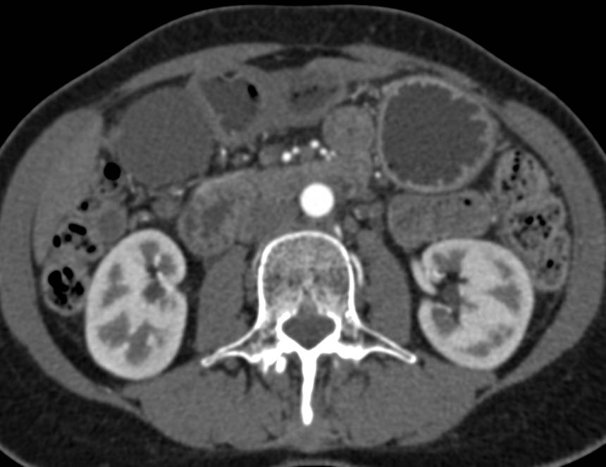 Normal Small Bowel on CT Enterography with Volumen - CTisus CT Scan