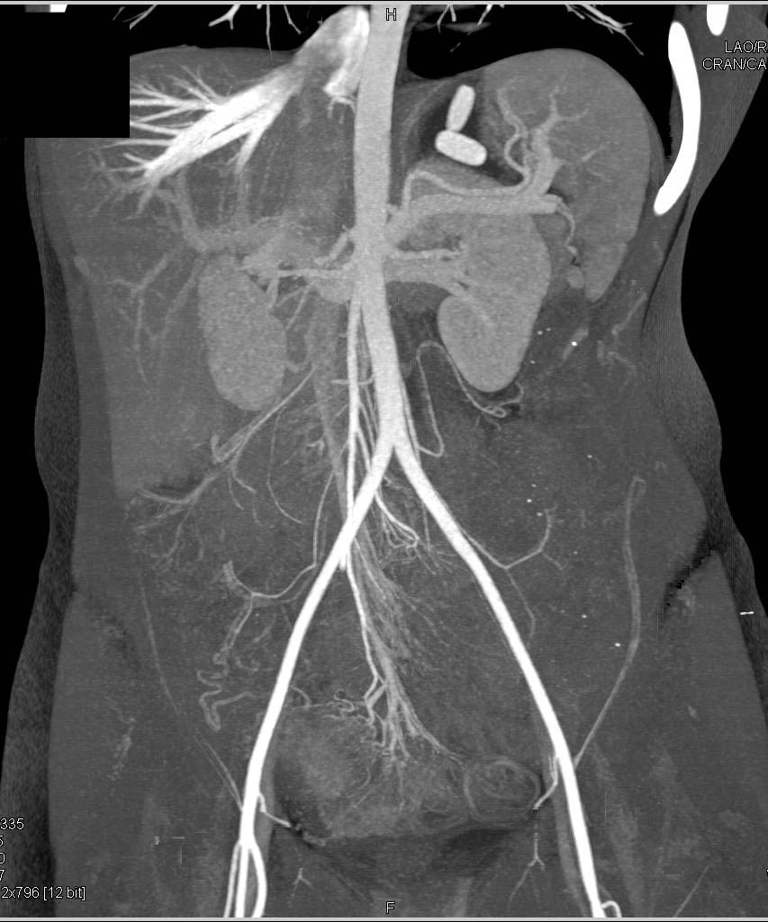 Crohn's Disease of the Small Bowel with CT Enterography - CTisus CT Scan