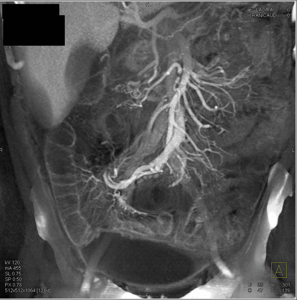 Crohn's Disease with a Pelvic Abscess - CTisus CT Scan