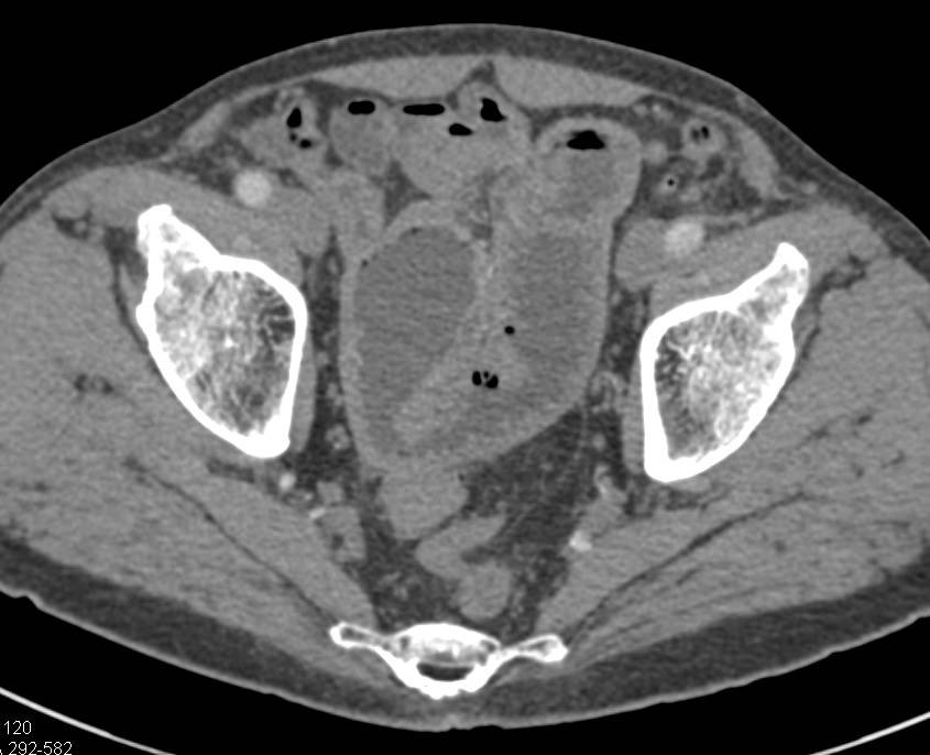 Crohn's Disease with Strictures and Early Small Bowel Obstruction (SBO) - CTisus CT Scan