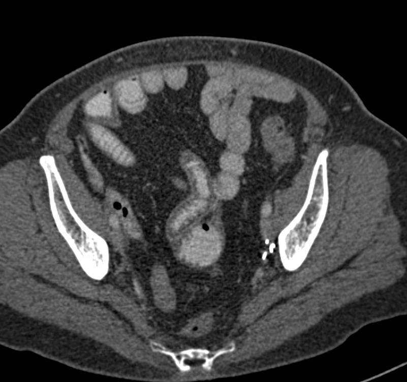 Radiation Enteritis Distal Small Bowel - CTisus CT Scan