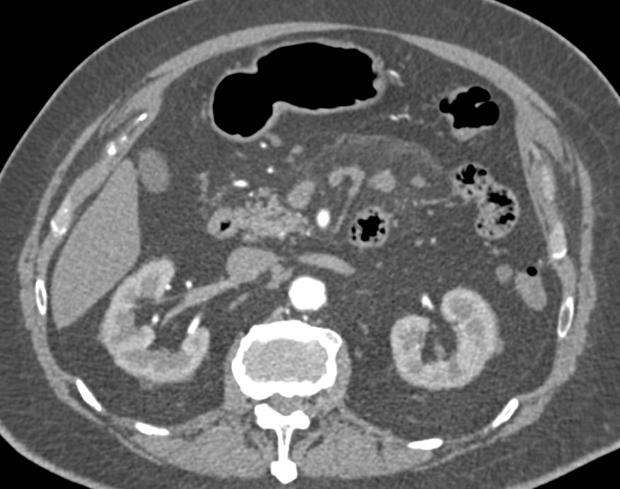 Mist Mesentery due to Mesenteric Panniculitis with Good Example of Haziness and Prominent Nodes - CTisus CT Scan