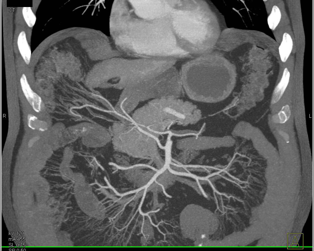 CTA in 3D of Small Bowel Mesentery - CTisus CT Scan