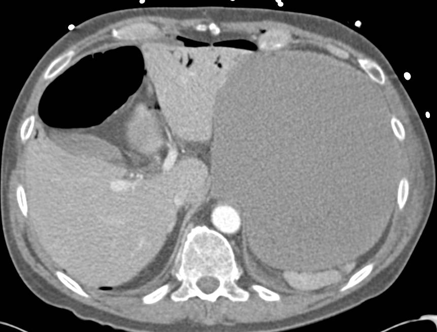 Ischemic Bowel with Portal Venous Air and Small Bowel Pneumatosis Nicely Shown in 3D - CTisus CT Scan