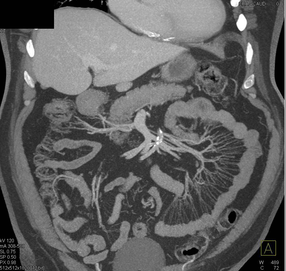 CTA of the Mesenteric Arcade - CTisus CT Scan