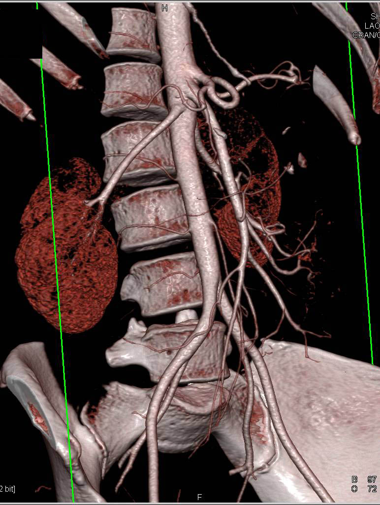 Normal Small Bowel and Mesenteric Arcade - CTisus CT Scan