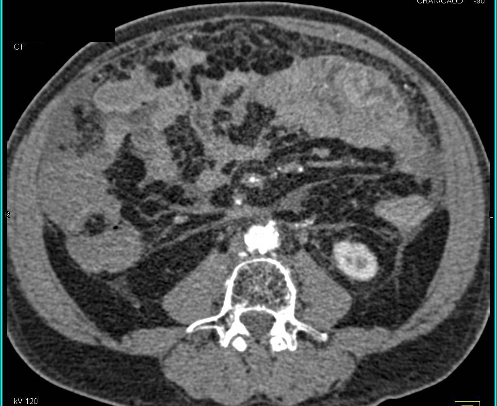 Carcinomatosis with Implants on the Mesentery and Omentum - CTisus CT Scan