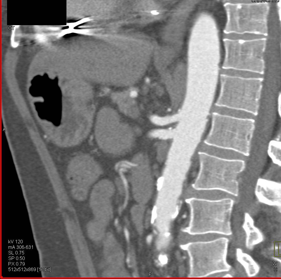 Adenocarcinoma of the Duodenum Best Seen in Coronal 3D VRT - CTisus CT Scan