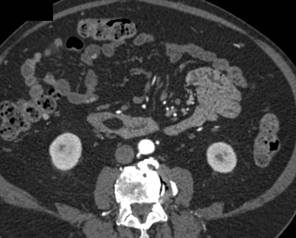 Beautiful Example of a Lipoma in the Duodenum on a Stalk - CTisus CT Scan
