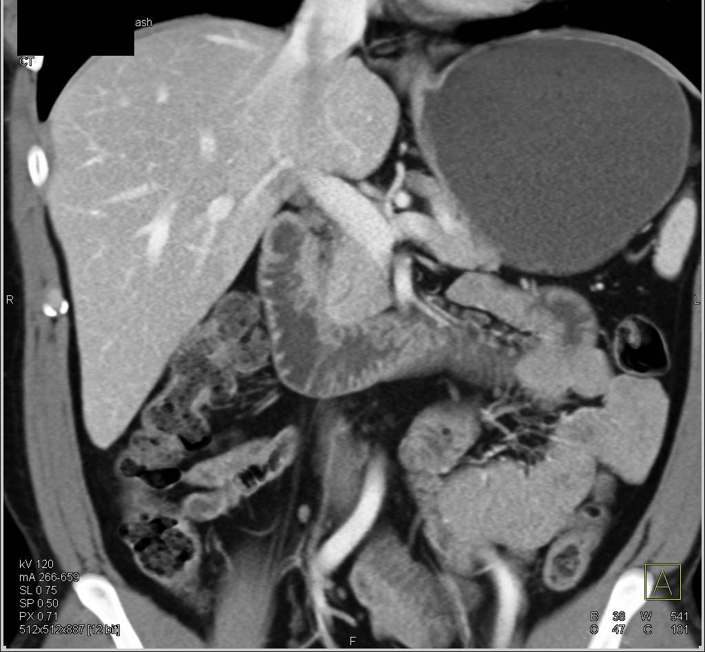 CT Enterography of Normal Duodenum - CTisus CT Scan