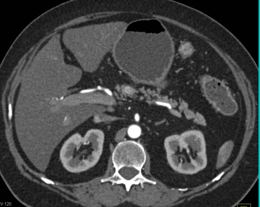 CT Enterography with Colitis Colon and Neuroendocrine Tumor in the Head of the Pancreas - CTisus CT Scan
