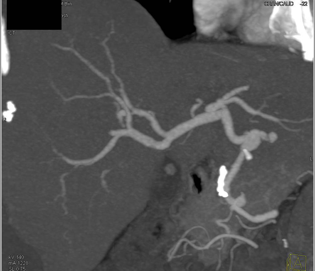 Vasculitis with Multiple Small Aneurysms off Hepatic Artery and SMA - CTisus CT Scan