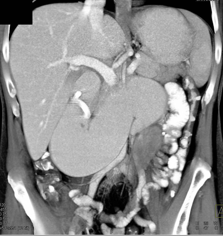 Small Bowel Obstruction due to Adhesions - CTisus CT Scan