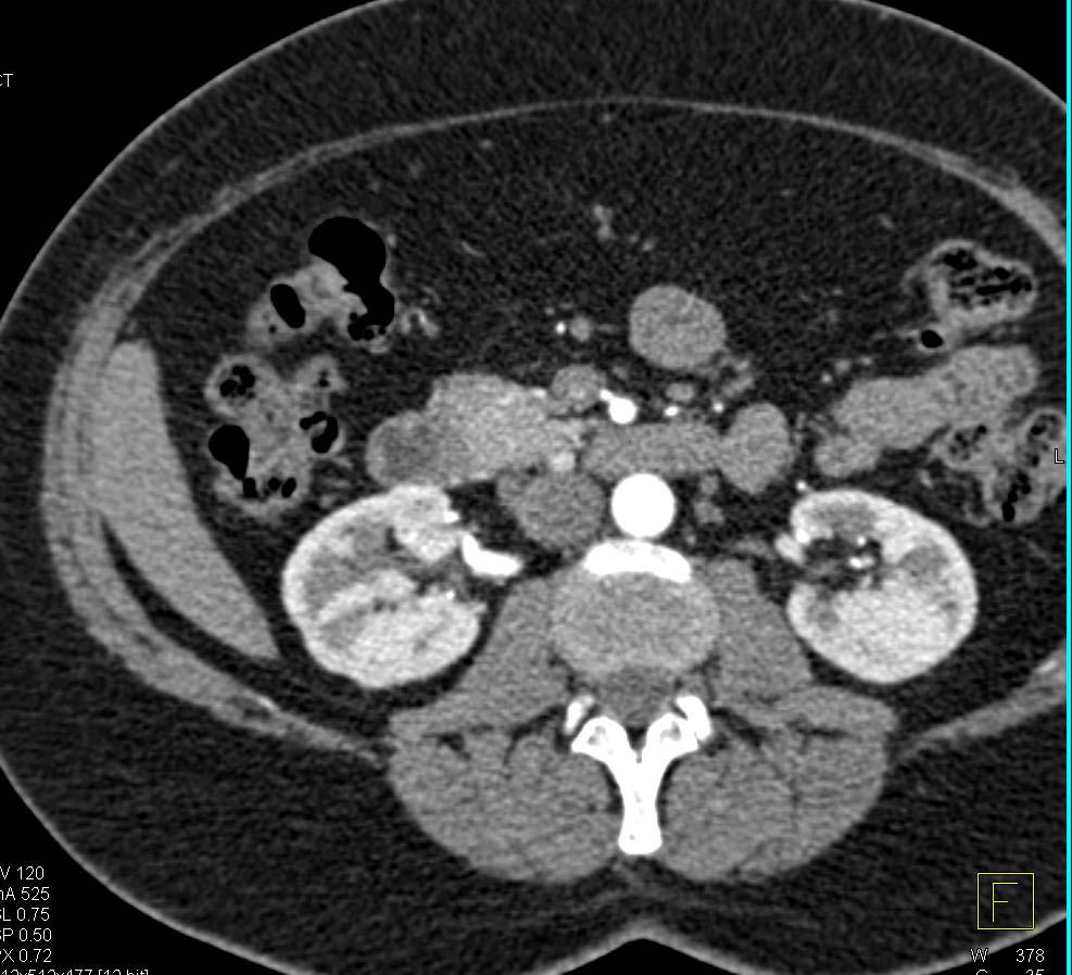 Carcinoid Tumor in the Mesentery - CTisus CT Scan