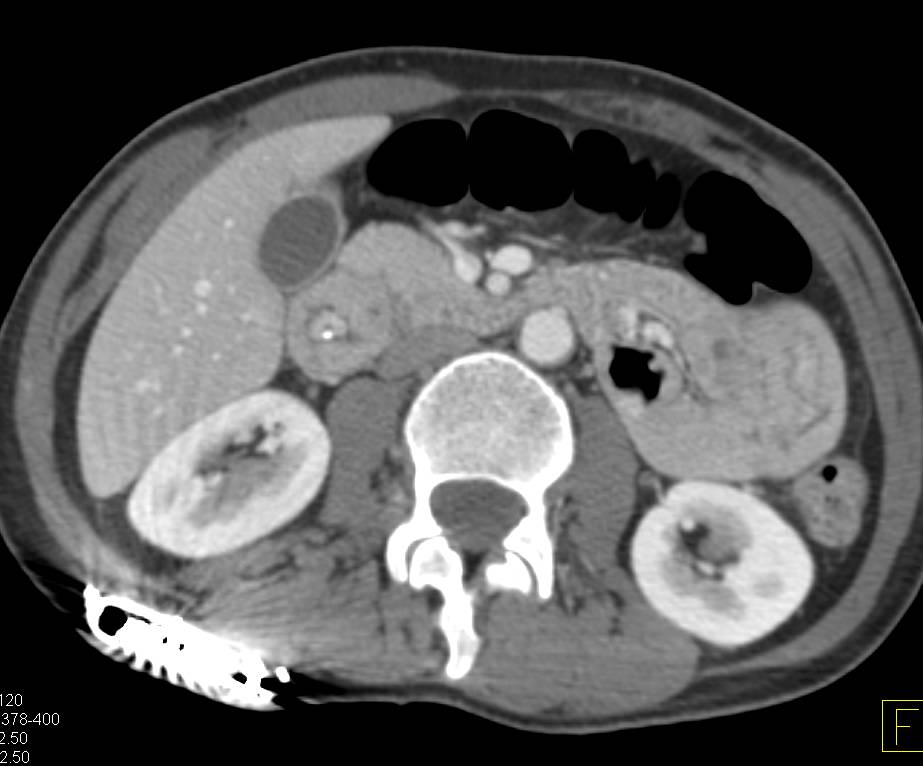 Neuroendocrine Tumor in the Duodenum - CTisus CT Scan