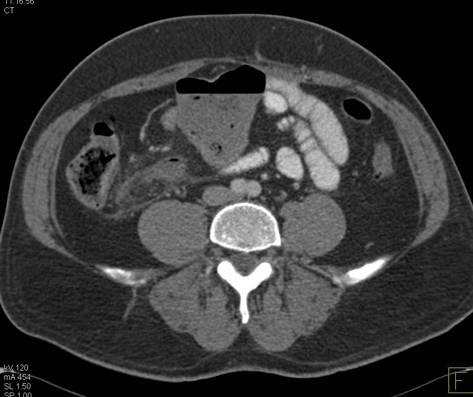 Acute Appendicitis - CTisus CT Scan