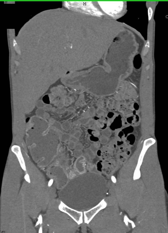 Focal Crohn's Disease and Bladder 