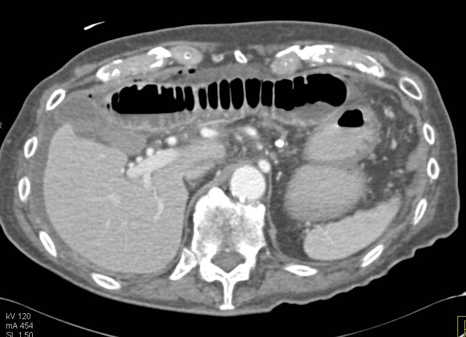 Small Bowel Obstruction due to an Internal Hernia with Adhesions - CTisus CT Scan