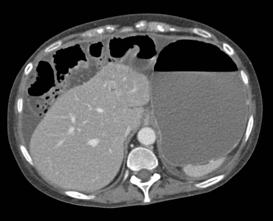 Distended Small Bowel with Pneumatosis and Fluid Filled Bowel in a Patient with Scleroderma - CTisus CT Scan