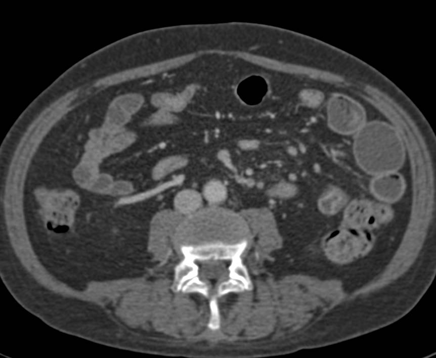 Crohn's Disease with Enhancing Proximal Small Bowel Loops seen best in 3D - CTisus CT Scan