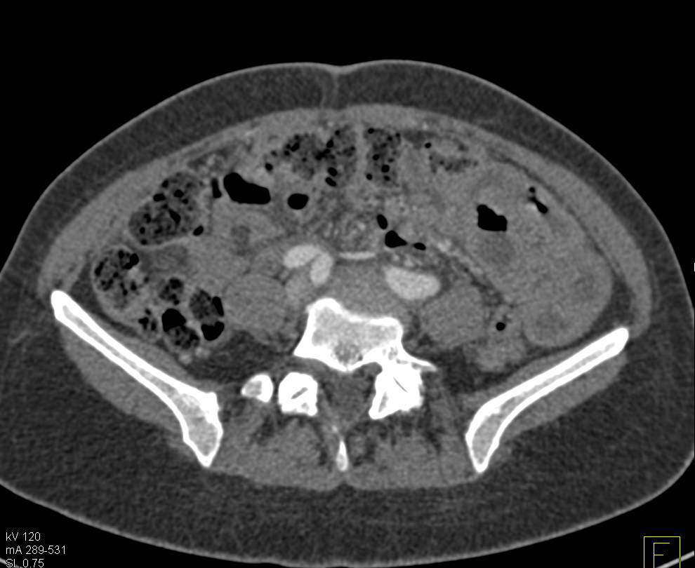 Unusual Case of a Small Bowel Mesothelioma - CTisus CT Scan