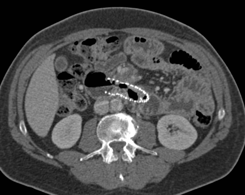 Infiltrating Pancreatic Cancer Obstructs Duodenum with Stent Placed in Duodenum - CTisus CT Scan