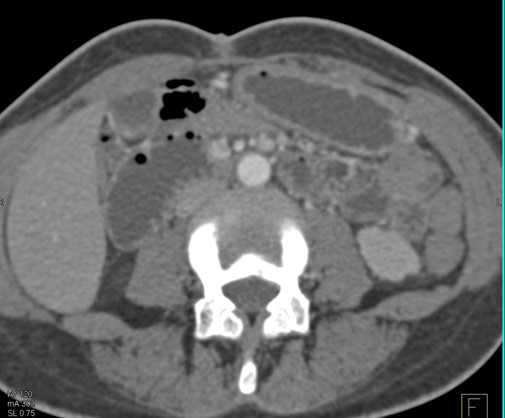Superior Mesenteric Artery (SMA) Syndrome with Dilated Duodenum - CTisus CT Scan
