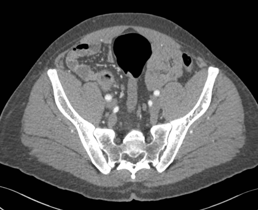 Crohn's Disease with Enhancing Terminal Ileum with Ulcerations - CTisus CT Scan