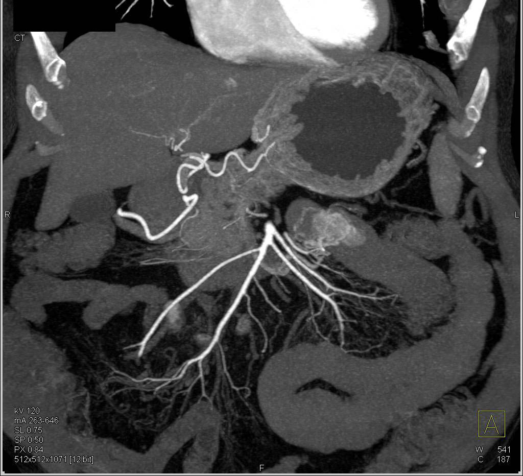 CT Enterography with GIST Tumor in the Proximal Small Bowel - CTisus CT Scan
