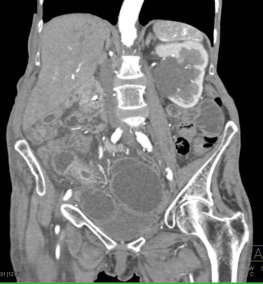 Small Bowel Obstruction due to Thickened Terminal Ileum in Crohn's Disease Patient - CTisus CT Scan