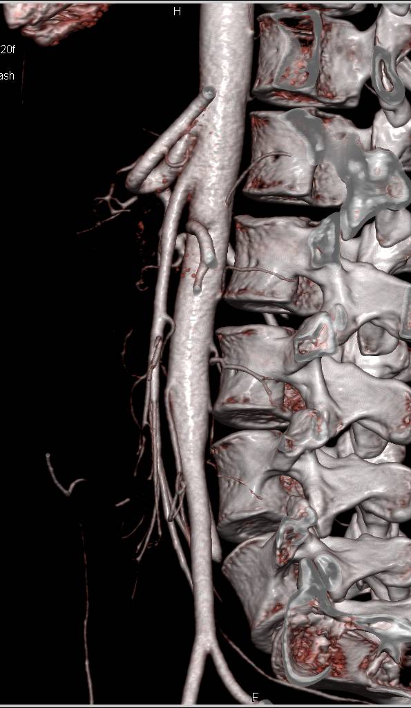 Superior Mesenteric Artery (SMA) Syndrome with Narrow SMA-Aorta Angle - CTisus CT Scan