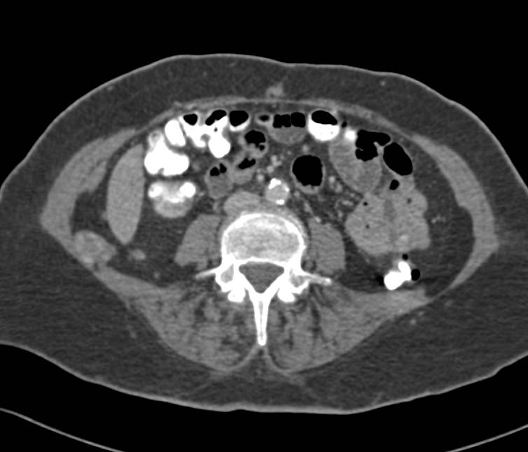 Small Bowel Angiosarcoma with Metastases to Liver and Lung - CTisus CT Scan