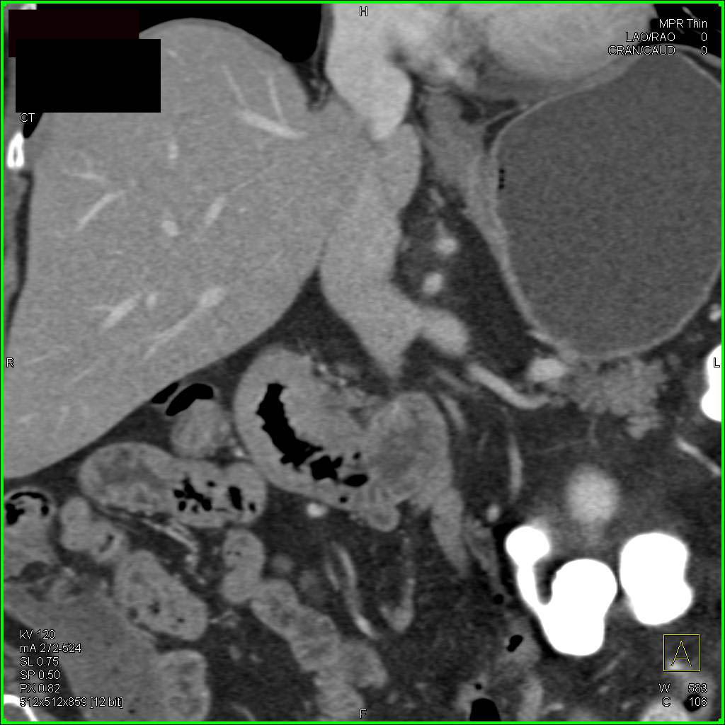 Subtle Duodenal Cancer - CTisus CT Scan