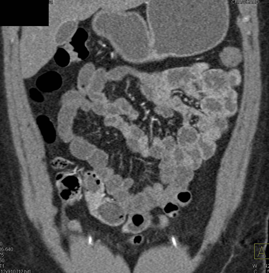 Crohn's Disease with Enhancing Segment in Distal Ileum - CTisus CT Scan