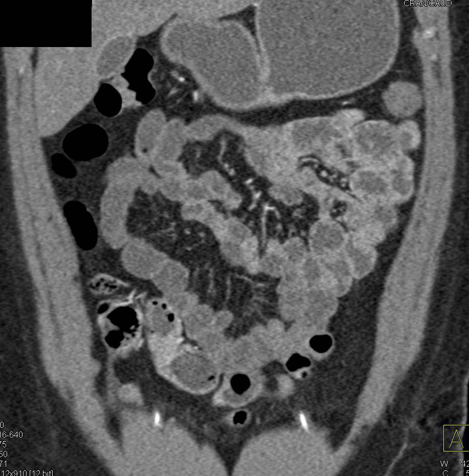 Crohn's Disease in Terminal Ileum - CTisus CT Scan
