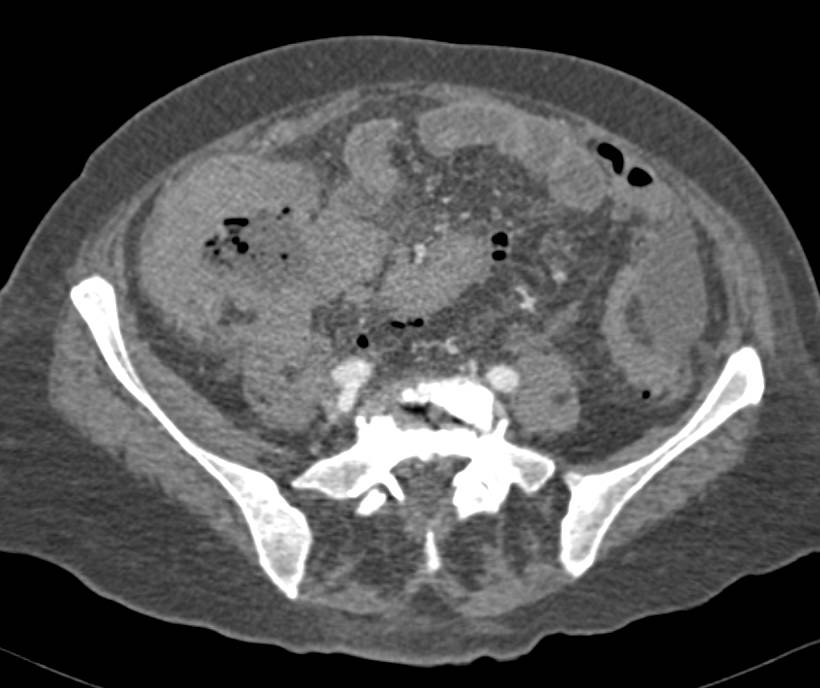 B-cell Lymphoma Involves the Ileum and Extends into the Cecum - CTisus CT Scan