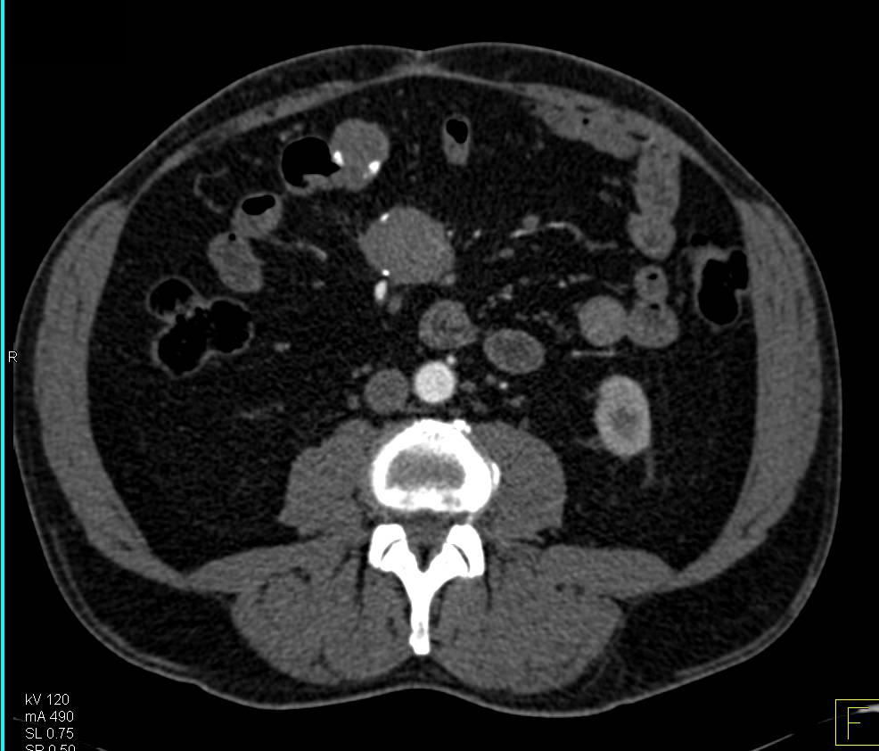 Carcinoid Tumor Root of Mesentery with Desmoplastic Reaction - CTisus CT Scan