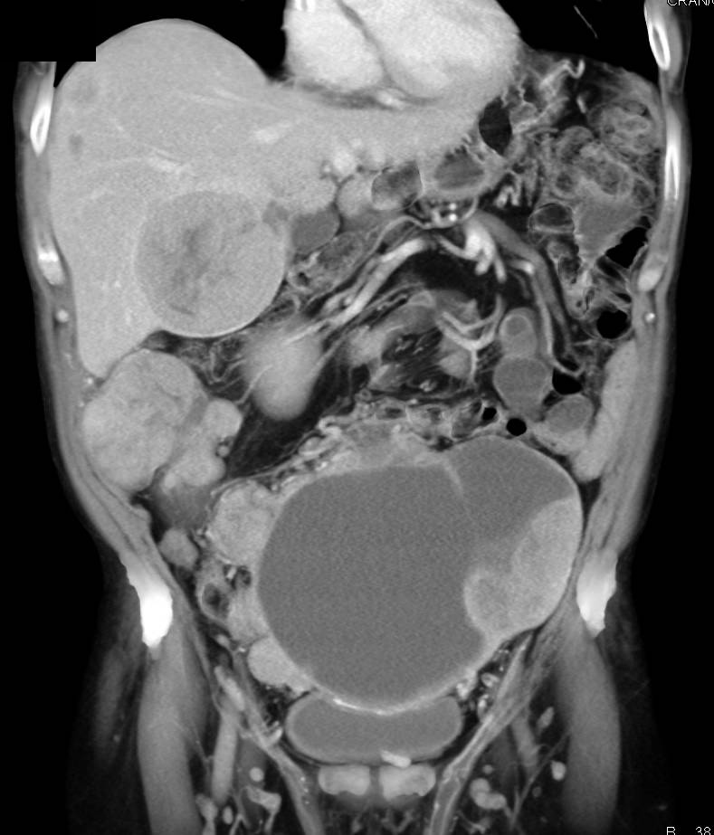 Small Bowel GIST Tumor with Cystic Metastases - CTisus CT Scan