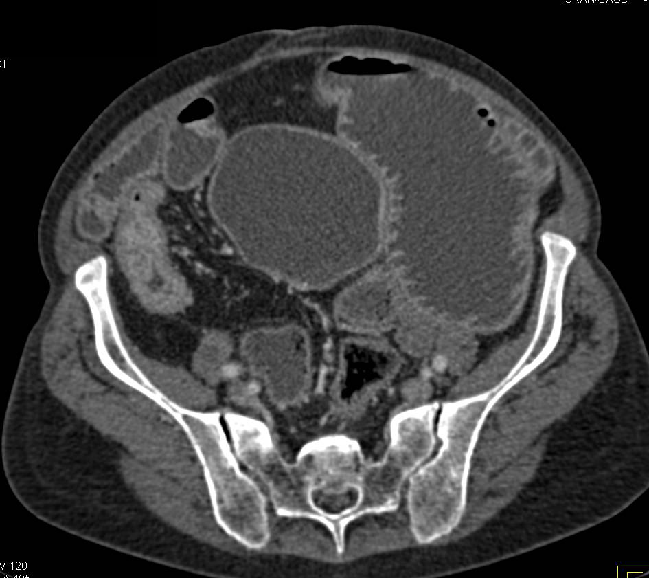 Crohn's Disease with Thickened Ileum and Small Bowel Obstruction (SBO) - CTisus CT Scan