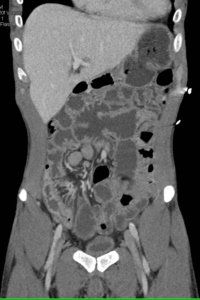 Active Crohn's Disease Terminal Ileum - CTisus CT Scan