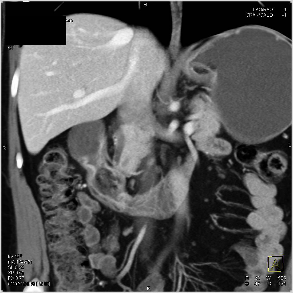 Intraluminal Duodenal Diverticulum Simulates A Duodenal Mass - CTisus CT Scan